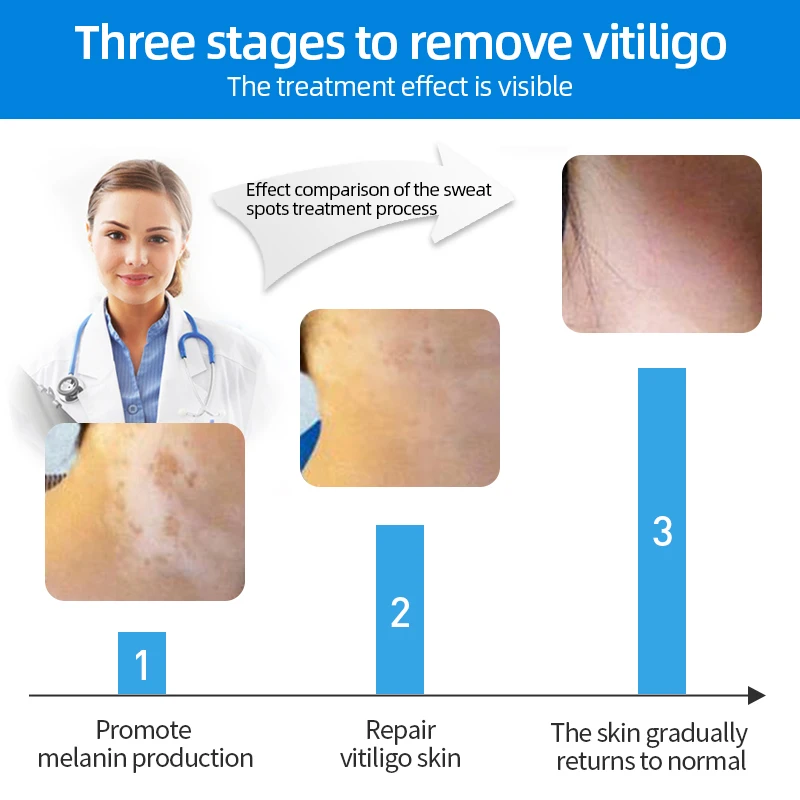 30ml 를 가진 백색 반점 제거제 스프레이 초본 항균 Vitiligo 처리 혈청 백반증 질환 멜라닌 색소 수리 몸은 얼굴을